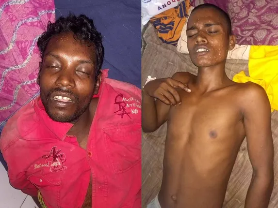 ଅନ୍ଧବିଶ୍ୱାସର କରୁଣ ପରିଣତି: ଗୁଣିଆର ଗରମ ‘ଧାନ-ସୋରିଷ-ଛୁଞ୍ଚି’ ଚିକିତ୍ସା