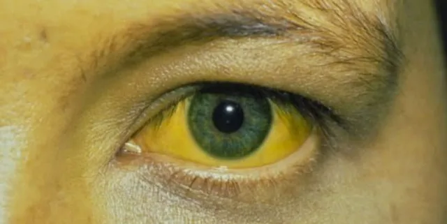 ମାଳି କଲୋନିରେ ଜଣ୍ଡିସ୍‌ : ସତ୍ୟସାଇ ସ୍କୁଲ ନିକଟରେ ଖାଦ୍ୟ ବିକ୍ରି ବନ୍ଦ