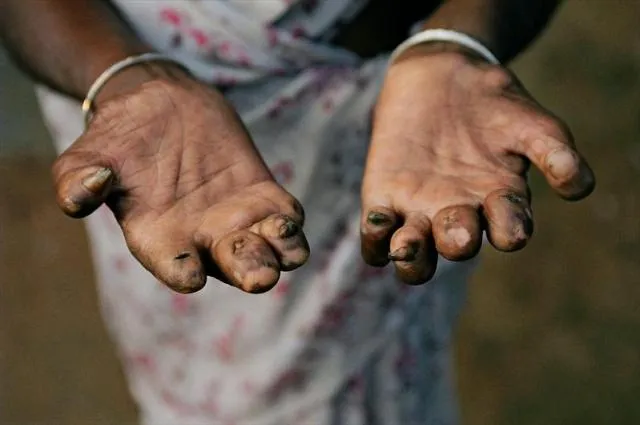 ‘କୁଷ୍ଠମୁକ୍ତ’ ଘୋଷଣା ପରେ ବି ରାଜ୍ୟରୁ ହଟୁନି ରୋଗ