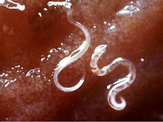 ୧୪ବର୍ଷର ପିଲା ପେଟରେ ପୋକ, ଶୋଷି ନେଲା ୨ବର୍ଷରେ ୨୨ଲିଟର ରକ୍ତ !