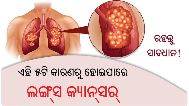 ଏହି ୫ଟି କାରଣରୁ ହୋଇପାରେ ଲଙ୍ଗ୍‌ସ କ୍ୟାନ୍‌ସର୍‌, ରହନ୍ତୁ ସାବଧାନ!
