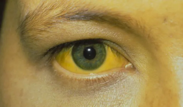 ଜଣ୍ଡିସ ଆକ୍ରାନ୍ତ ଗାଁରୁ ବାସନ୍ଦ