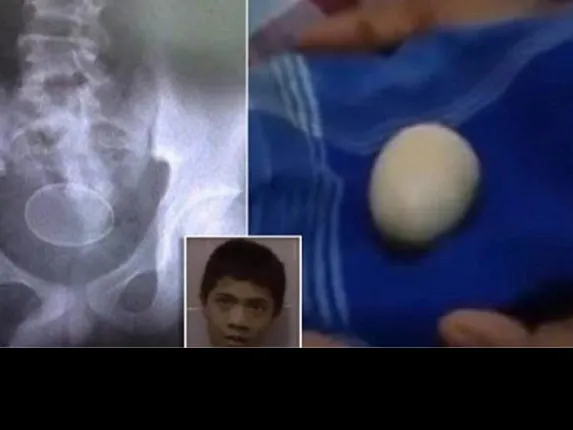 ଦୁଇବର୍ଷ ଭିତରେ ଏହି ବାଳକ ଦେଇଛି ୨୦ଟି ଅଣ୍ଡା, ଜାଣନ୍ତୁ ପ୍ରକୃତ ଘଟଣାଟି କ’ଣ