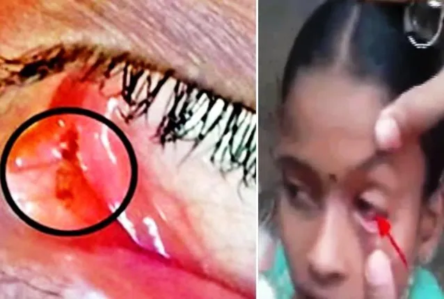 ୧୧ ବର୍ଷ ଝିଅର ଆଖିରୁ ବାହାରୁଛି ମଲା ପିମ୍ପୁଡ଼ି : ଡ଼ାକ୍ତର ମଧ୍ୟ ଜାଣି ପାରୁ ନାହାନ୍ତି କାରଣ