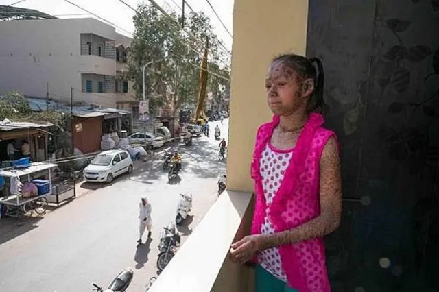 ବିରଳ ରୋଗ ପାଇଁ ‘ସର୍ପକନ୍ୟା’ ପାଲଟିଛନ୍ତି ନାବାଳିକା