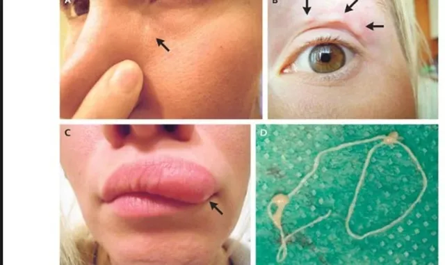 ମଶା କାମୁଡିବା ହେତୁ ମହିଳାଙ୍କ ଆଖି ତଳର ଚର୍ମ ଭିତରେ ରହିଯାଇଥିଲା ରକ୍ତ ଶୋଷକ କୀଟ...ଏପରି ଭାବେ ଜଣାପଡ଼ିଲା