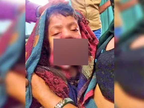 ମୋବାଇଲ ବ୍ୟାଟେରି ଫାଟି ଶିଶୁକନ୍ୟାର ମୁହଁ କ୍ଷତବିକ୍ଷତ ହୋଇଗଲା : ଶିଶୁକୁ ଦେଖି ଡାକ୍ତର ବି ଡରିଗଲେ !