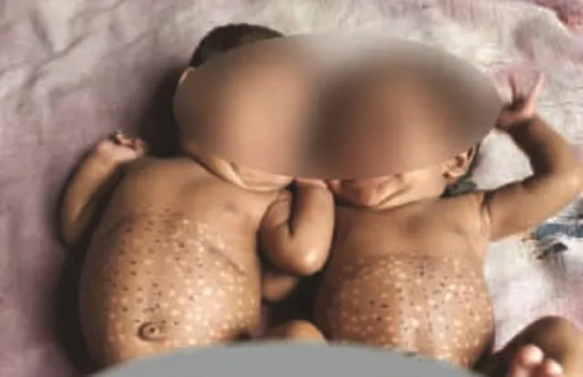 ଦୁଇ ଶିଶୁଙ୍କୁ ଚେଙ୍କ, ଅବସ୍ଥା ଗୁରୁତର