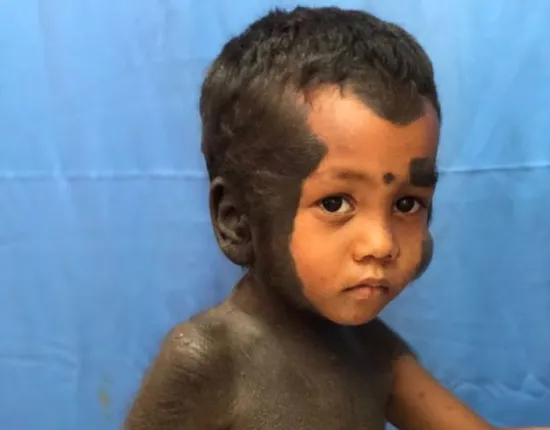 ଲୋମଶ ମୁହଁରୁ ମିଳିବ ମୁକ୍ତି : ନୂଆ ଚେହେରା ପାଇବେ ସୁନ୍ଦରଗଡ଼ର ‘ସ୍ୱସ୍ତିକ୍‌’