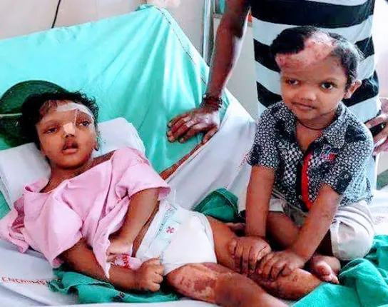 ପୁଣି ଦୁଇ ଯୋଡ଼ା ଶିଶୁ ଏମ୍ସରେ ଭର୍ତ୍ତି ହେଲେ : ସ୍ଥିତି ସମୀକ୍ଷା କରୁଛନ୍ତି ଡାକ୍ତରୀ ଦଳ