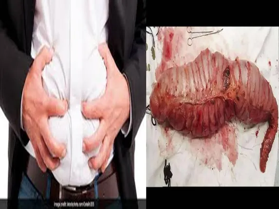 ଯୁବକଙ୍କ ପେଟରୁ ବାହାରିଲା ୧୩ କିଲୋ ଓଜନ ଓ ୩୦ଇଞ୍ଚ ଲମ୍ବର ଏପରି କିଛି, ଯାହାକୁ ଦେଖି ଡାକ୍ତର ହୋଇଗଲେ ଆଶ୍ଚର୍ଯ୍ୟ