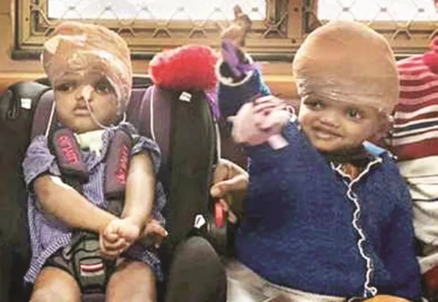 ଜଗା-ବଳିଆଙ୍କୁ ଚିକିତ୍ସା କରିଥିବା ଡାକ୍ତରୀ ଟିମ୍‌କୁ କୃତଜ୍ଞତା ଜଣାଇଲେ ସରକାର