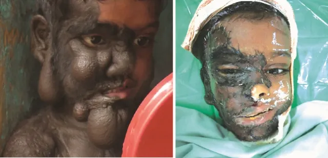 କାହ୍ନା ପାଇଲା ନୂଆ ଚେହେରା : ଖୋଲିଲା ପଟି, ଆଉ ୧୦ଦିନ ଆଇସିୟୁରେ ରହିବ