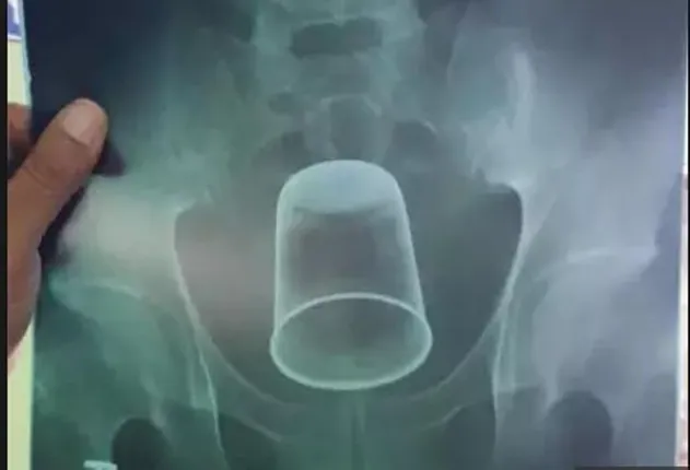 ଏକ୍ସରେ ରିପୋର୍ଟରୁ ପୀଡିତଙ୍କ ପେଟରେ ଏକ ଷ୍ଟିଲ ଗ୍ଲାସ ଥିବା ଜାଣିବା ପରେ ଡାକ୍ତର ବି ହୋଇଗଲେ ଆଶ୍ଚର୍ଯ୍ୟ