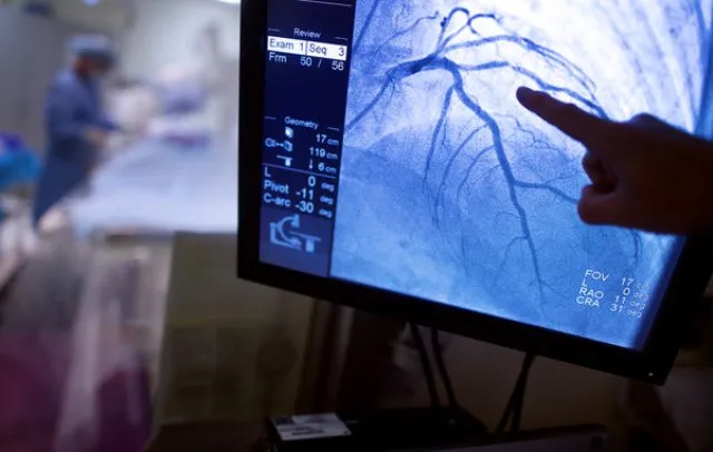 ଏସ୍‌ସିବିରେ ପୁଣି ଆରମ୍ଭ ହେଲା ଆଞ୍ଜିଓଗ୍ରାମ୍