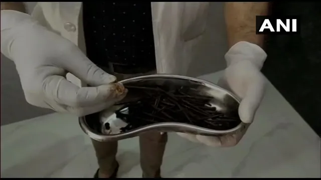 ରୋଗୀଙ୍କ ପେଟରୁ ବାହାରିଲା ୧୧୬ଟି ଲୁହା କଣ୍ଟା, ଡାକ୍ତର ହୋଇଗଲେ ତାଜୁବ