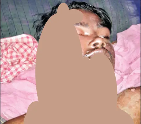 ଯୁବକଙ୍କ ମୁହଁରେ ଗରମ ତେଲ ଢାଳିଦେଲେ, ଗୁରୁତର ଅବସ୍ଥାରେ ଏସ୍‌ସିବି ସ୍ଥାନାନ୍ତର