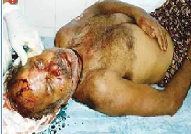 ବିଦ୍ୟୁତ୍ ଆଘାତରେ ଲାଇନ୍‌ମ୍ୟାନ୍‌ ଗୁରୁତର