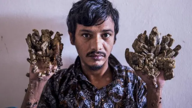 ଯନ୍ତ୍ରଣା ସହି ନ ପାରି ଶେଷରେ ନିଜ ହାତ କାଟି ଦେବାକୁ ଡ଼ାକ୍ତରଙ୍କୁ ଅନୁରୋଧ କଲେ ବାଂଲାଦେଶୀ ଟ୍ରି ମ୍ୟାନ୍‌