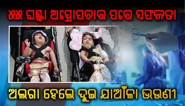 ୫୫ ଘଣ୍ଟାର ଅସ୍ତ୍ରୋପଚାର ପରେ ସଫଳତାର ସହ ଅଲଗା ହେଲେ ଦୁଇ ଯାଆଁଳା  ଭଉଣୀ