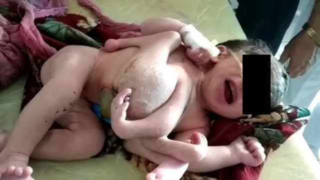 ଚାରିଟି ହାତ ନେଇ ଜନ୍ମ ନେଲା ବିଚିତ୍ର ଶିଶୁ, ନବଜାତକୁ ଦେଖିବା ପାଇଁ ହସ୍‌ପିଟାଲ୍‌ରେ ପ୍ରବଳ ଭିଡ