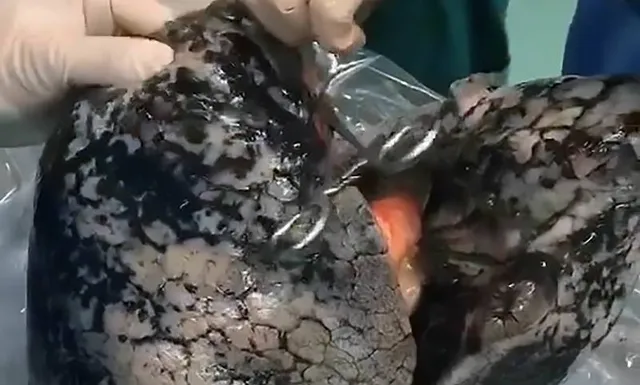 ଦିନକୁ ୧୦ଟି ସିଗାରେଟ ଟାଣୁଥିବା ବ୍ୟକ୍ତିଙ୍କର ଫୁସଫୁସ ଦେଖି ଡାକ୍ତର ବି ହୋଇଗଲେ ଆଶ୍ଚର୍ଯ୍ୟ!