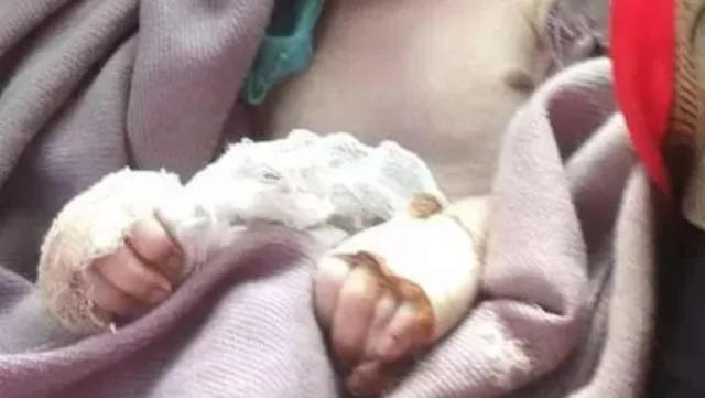 ନବଜାତ ହାତରେ ୬ଟି ଆଙ୍ଗୁଠି ଥିବାରୁ କାଟିଦେଲେ ନର୍ସ, ଶିଶୁର ମୃତ୍ୟୁ ଅଭିଯୋଗ