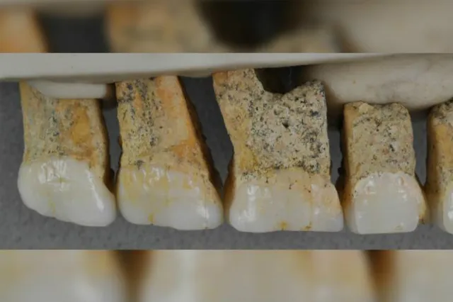 ନାସାରନ୍ଧ୍ରରେ ବଢ଼ୁଥିବା ଦାନ୍ତକୁ ସଫଳତାର ସହ ଅସ୍ତ୍ରୋପଚାର କରି କାଢ଼ିଲେ ଡାକ୍ତର