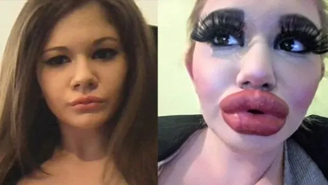 ବାର୍ବି ଡଲ୍ ବନିବାର ଇଚ୍ଛା ମହଙ୍ଗା ପଡ଼ିଲା, ୪ଗୁଣ ବଢ଼ିଗଲା ଓଠର ଆକାର