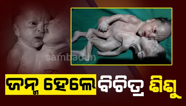 ଜନ୍ମ ନେଲା ଚାରିଟି ଗୋଡ଼, ଚାରିଟି ହାତ ଓ ଦୁଇଟି ମୁଣ୍ଡ ଥିବା ବିଚିତ୍ର ଶିଶୁ