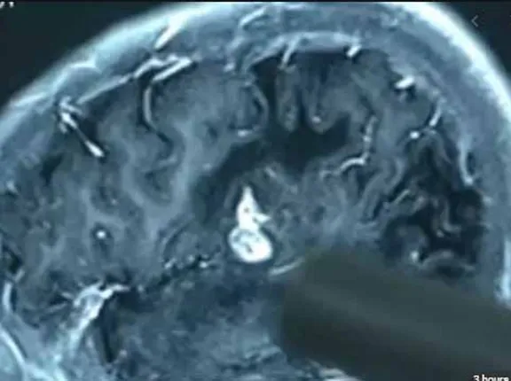 ଯୁବକଙ୍କ ମସ୍ତିଷ୍କରେ ୧୭ବର୍ଷ ଧରି ରହିଥିବା ପୋକକୁ ସୁରକ୍ଷିତ ଅସ୍ତ୍ରୋପଚାର କରି ବାହାର କଲେ ଡାକ୍ତର