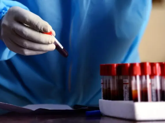 କରୋନା ମୃତ୍ୟୁହାର ହ୍ରାସ କରିବାରେ ପ୍ଲାଜମା ଥେରାପି ପ୍ରଭାବଶାଳୀ ନୁହେଁ : ଏମ୍ସ