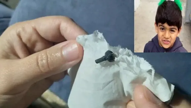 ୭ବର୍ଷ ଶିଶୁର ନାକ ଭିତରୁ ବାହାରିଲା ୨ବର୍ଷ ପୂର୍ବେ ପଶି ହଜି ଯାଇଥିବା ଖେଳନା