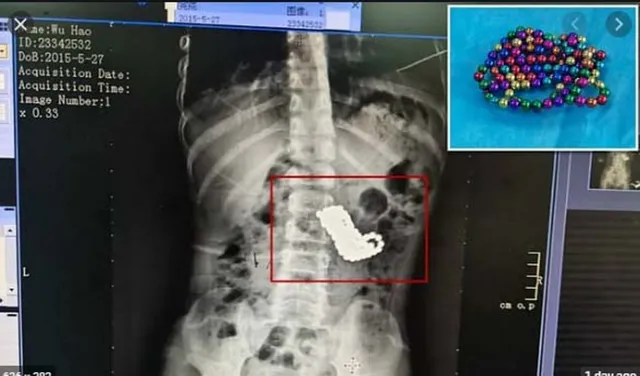  ଶିଶୁର ପେଟ ଅସ୍ତ୍ରୋପଚାର କରି ଡାକ୍ତର ବାହାର କଲେ ୧୨୩ଟି ଚୁମ୍ବକ ବଲ୍