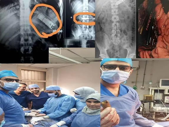 ସାଙ୍ଗ ସହିତ ବାଜି ଲଗାଇ ଯୁବକ ଗିଳି ଦେଇଥିଲେ ମୋବାଇଲ ଫୋନ; ୭ମାସ ପରେ ଅସ୍ତ୍ରୋପଚାର କରି କାଢ଼ିଲେ ଡାକ୍ତର