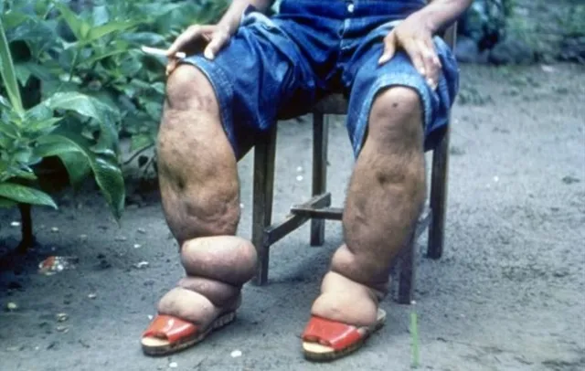 ଫାଇଲେରିଆ ଦୂରୀକରଣ ପାଇଁ ୧୦ରୁ ସାମୂହିକ ଔଷଧ ସେବନ କାର୍ଯ୍ୟକ୍ରମ