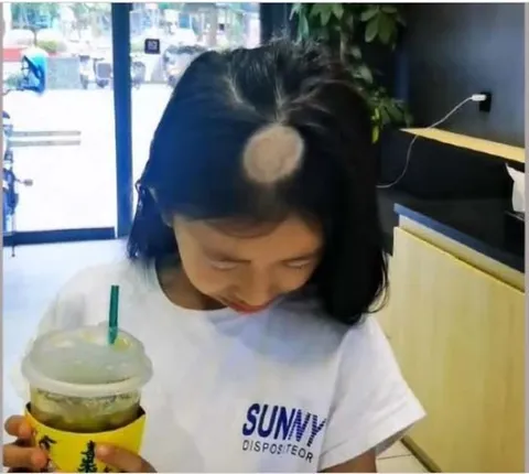 ବିଲେଇ ଠାରୁ ଶିଶୁକୁ ହେଲା ସଂକ୍ରମଣ, ଆକସ୍ମିକ ଭାବେ ଝାଡ଼ିବାକୁ ଲାଗିଲା ମୁଣ୍ଡର କେଶ