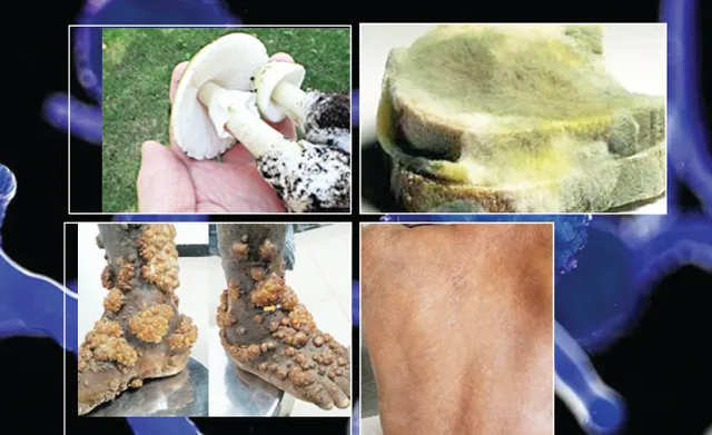 ବ୍ଲାକ ଫଙ୍ଗସ୍‌: କାରଣ, ନିରାକରଣ