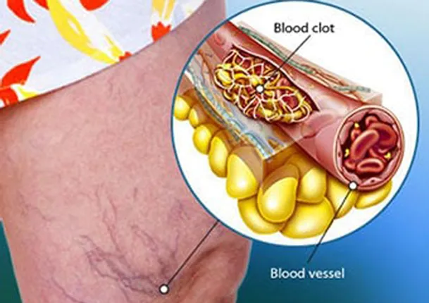 ରକ୍ତ ଜମାଟ ବାନ୍ଧିବା ଜଟିଳତା ଆଣୁଛି ଅଙ୍ଗ ହରାଇବା ଆଶଙ୍କା