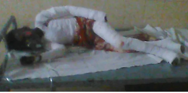 ବିଦ୍ୟୁତ୍‌ ଆଘାତପ୍ରାପ୍ତ ନାବାଳକର ଚିକିତ୍ସାରେ ଅର୍ଥ ବାଧକ