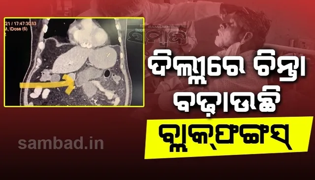 ବ୍ଲାକଫଙ୍ଗସ ବଢ଼ାଇଲା ଡାକ୍ତରଙ୍କ ଚିନ୍ତା, ଦିଲ୍ଲୀର ଗଙ୍ଗାରାମ ହସ୍ପିଟାଲରେ ମିଳିଲା ଦୁଇଟି ବିରଳ କେସ