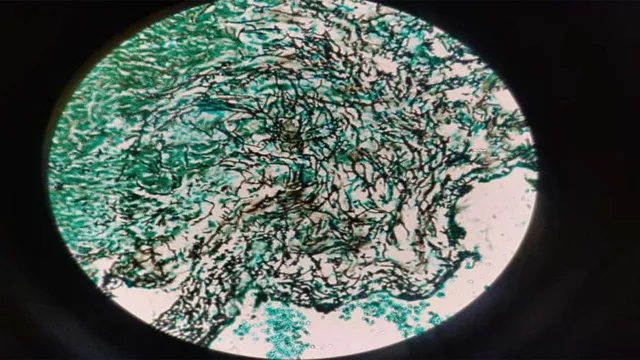 ହ୍ୱାଇଟ ଫଙ୍ଗସ ଯୋଗୁଁ ମହିଳାଙ୍କ ଅନ୍ତନଳୀରେ ହେଲା କଣା, ଦିଲ୍ଲୀରୁ ଆସିଲା ବିଶ୍ୱର ପ୍ରଥମ ମାମଲା