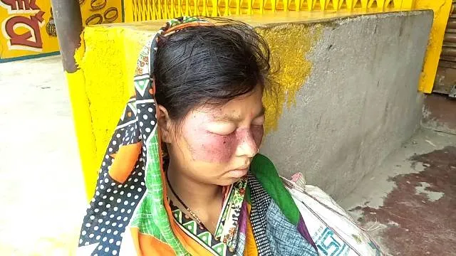 ଫେସ୍‌କ୍ରିମ ମୁହଁରେ ଲଗାଇ ମହିଳା ଗୁରୁତର