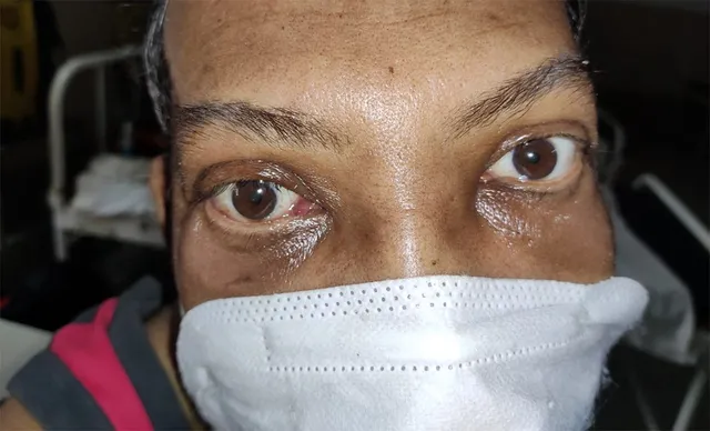 ଭିମସାର୍‌ରେ ହେଲାଣି ୭ ବ୍ଲାକ୍‌ ଫଙ୍ଗସ୍‌ ରୋଗୀଙ୍କ ଅସ୍ତ୍ରୋପଚାର, ଆସିଲାଣି ୧୨୦ ଭାଏଲ୍‌ ଇଂଜେକ୍‌ସନ୍