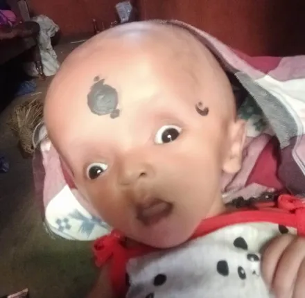 ଅସ୍ବାଭାବିକ ଭାବେ ବଢୁଛି ଶିଶୁପୁତ୍ରର ମୁଣ୍ଡ, ଚିକିତ୍ସା ପାଇଁ ସାଜିଛି ଅର୍ଥ ବାଧକ 