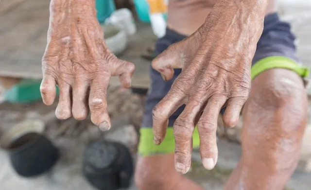 ରାଜ୍ୟରେ ହ୍ରାସ ପାଉଛି ନୂଆ କୁଷ୍ଠ ଆକ୍ରାନ୍ତଙ୍କ ସଂଖ୍ୟା