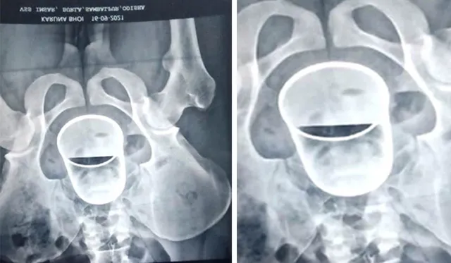 ଯୁବକଙ୍କ ମଳଦ୍ୱାରରୁ ବାହାରିଲା ଷ୍ଟିଲ୍‌ଗ୍ଲାସ୍‌, ଭିମସାର ଡାକ୍ତରୀ ଟିମ୍‌ କଲେ ଅସ୍ତ୍ରୋପଚାର