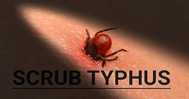 ଘାରିଲା ସ୍କ୍ରବ୍ ଟାଇଫସ୍ ଭୟ: ଆଇଜିଏମ୍‌ ଏଲିସା କିଟ୍‌ କିଣିବା ଲାଗି ଜିଲ୍ଲାକୁ ନିର୍ଦେଶ