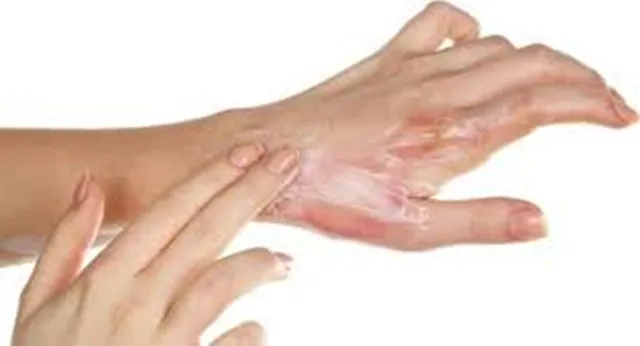 ବାଣ ଫୁଟାଉଥିବା ସମୟରେ ଶରୀରର କୌଣସି ସ୍ଥାନରେ ନିଆଁ ଲାଗିଗଲେ ଏପରି ଭାବେ କରନ୍ତୁ ପ୍ରାଥମିକ ଉପଚାର