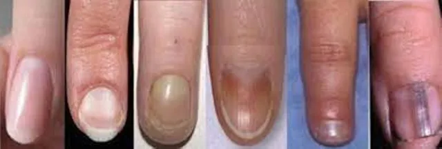 ନଖରେ ଏଭଳି ପରିବର୍ତ୍ତନ ଦେଖୁଛନ୍ତି କି, ହୋଇଯାଆନ୍ତୁ ସାବଧାନ!